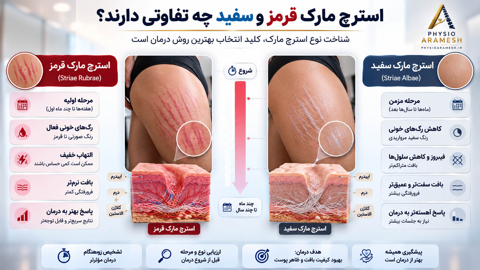 تفاوت ترک پوستی یا استرچ مارک سفید و قرمز چیست